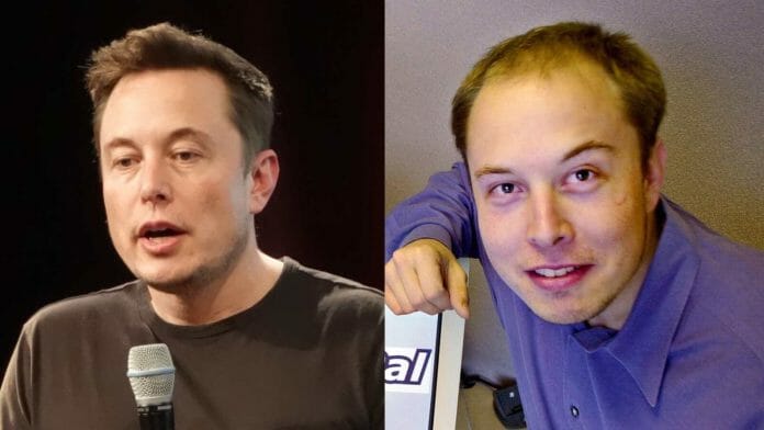 Elon Musk before and after his hair transplant