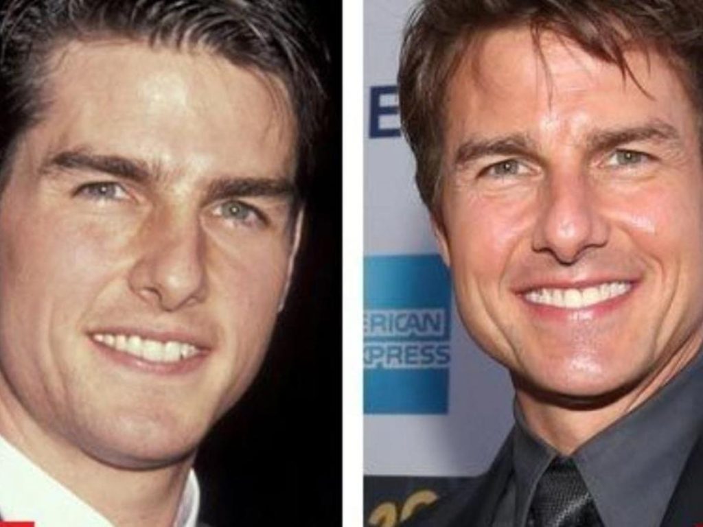 Tom Cruise fixed his smile