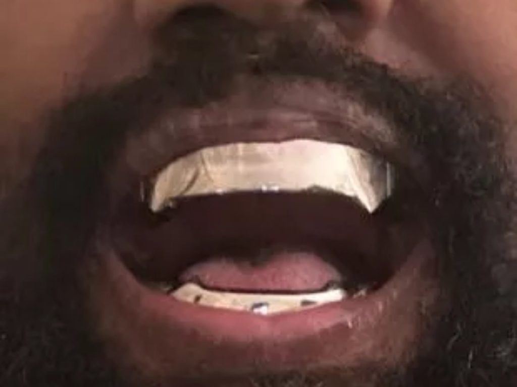 Kanye West’s $850,000 Titanium Smile 